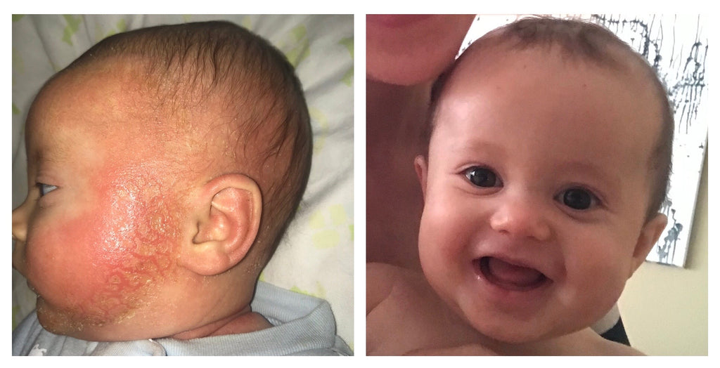 Discovering my Baby's Severe Eczema Triggers & Allergies -A 1 Year Timeline with Pictures