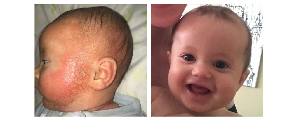 Discovering my Baby's Severe Eczema Triggers & Allergies -A 1 Year Timeline with Pictures